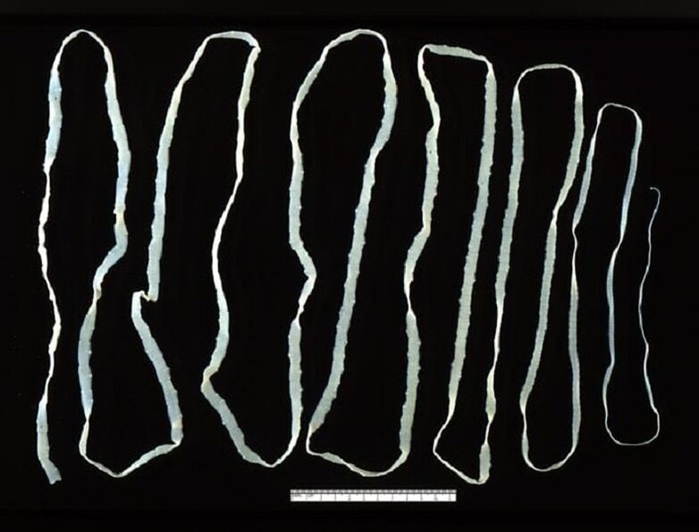 Tapeworm extracted from human intestine