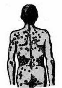 Possible infection diagram