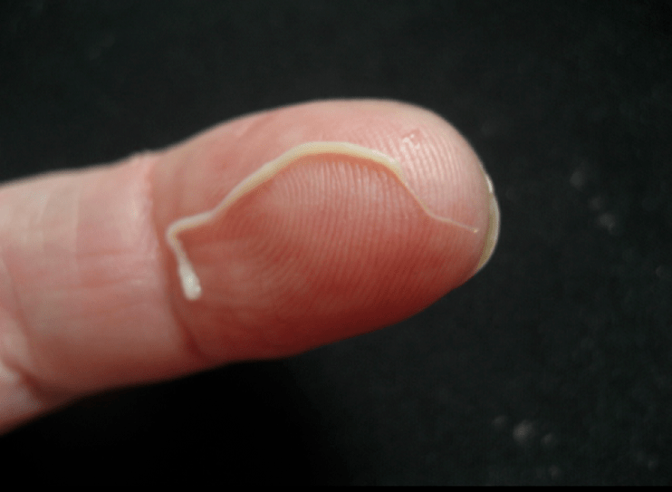 roundworm parasite of the human body